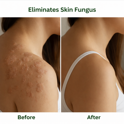 FungiFree